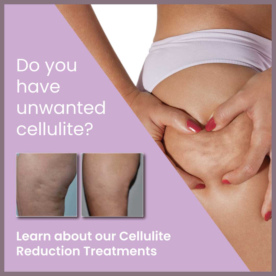 Cellulite - FM Aesthetics Inc